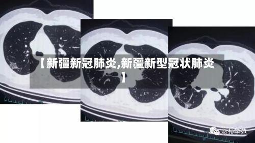 【新疆新冠肺炎,新疆新型冠状肺炎】-第2张图片