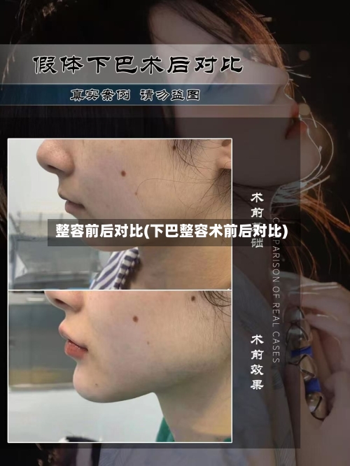 整容前后对比(下巴整容术前后对比)-第1张图片