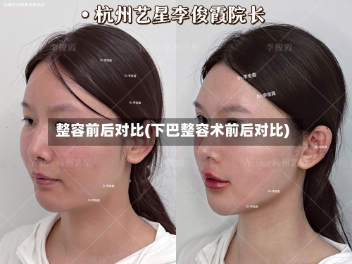 整容前后对比(下巴整容术前后对比)-第3张图片