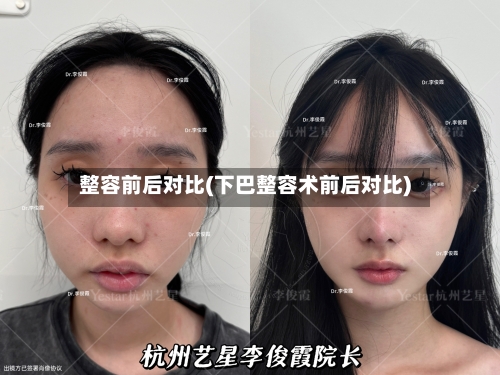 整容前后对比(下巴整容术前后对比)-第2张图片